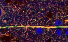 Descubren alteraciones en las proteínas del hipocampo en enfermos de Parkinson