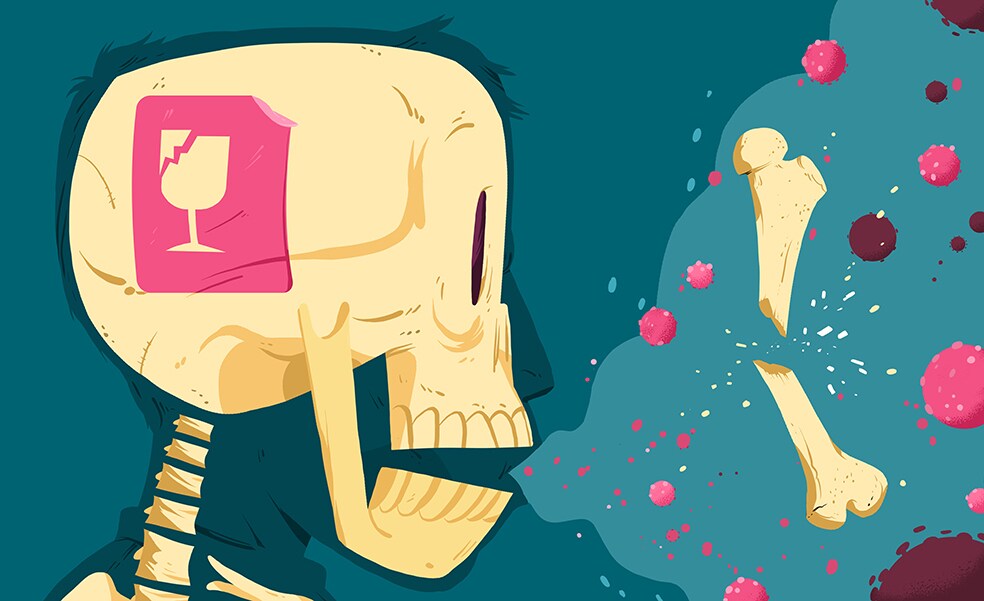 Cuando un estornudo puede romperte los huesos, así es la osteoporosis