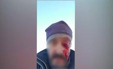 Pierde un ojo tras ser agredido por dos hombres cazando ilegalmente
