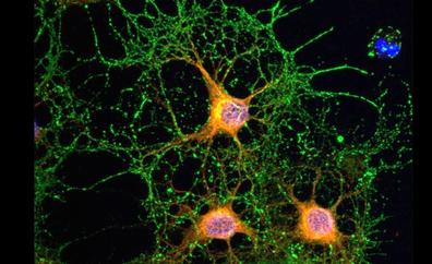 Identifican proteínas que provocan la muerte de neuronas en enfermos de Alzheimer