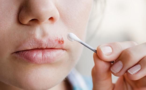 ¿Por qué nos salen herpes en los labios?