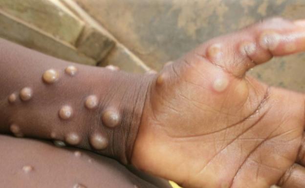 Madrid estudia si hay vínculo entre los casos de viruela del mono y el Maspalomas Pride