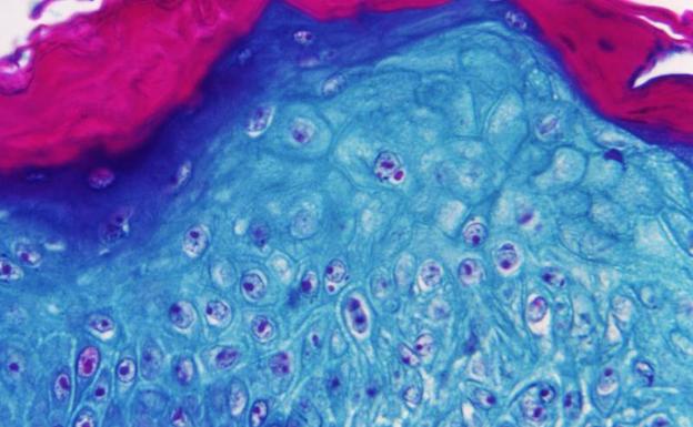 Canarias registra el segundo positivo de viruela del mono