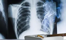 Investigadores españoles aumentan la esperanza del cáncer de pulmón