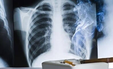 Investigadores españoles aumentan la esperanza del cáncer de pulmón