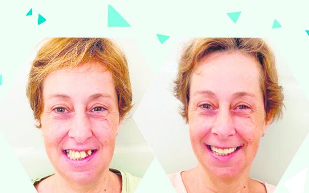 Elige implante sencillo o tres cirugías...